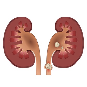 Renal Stone