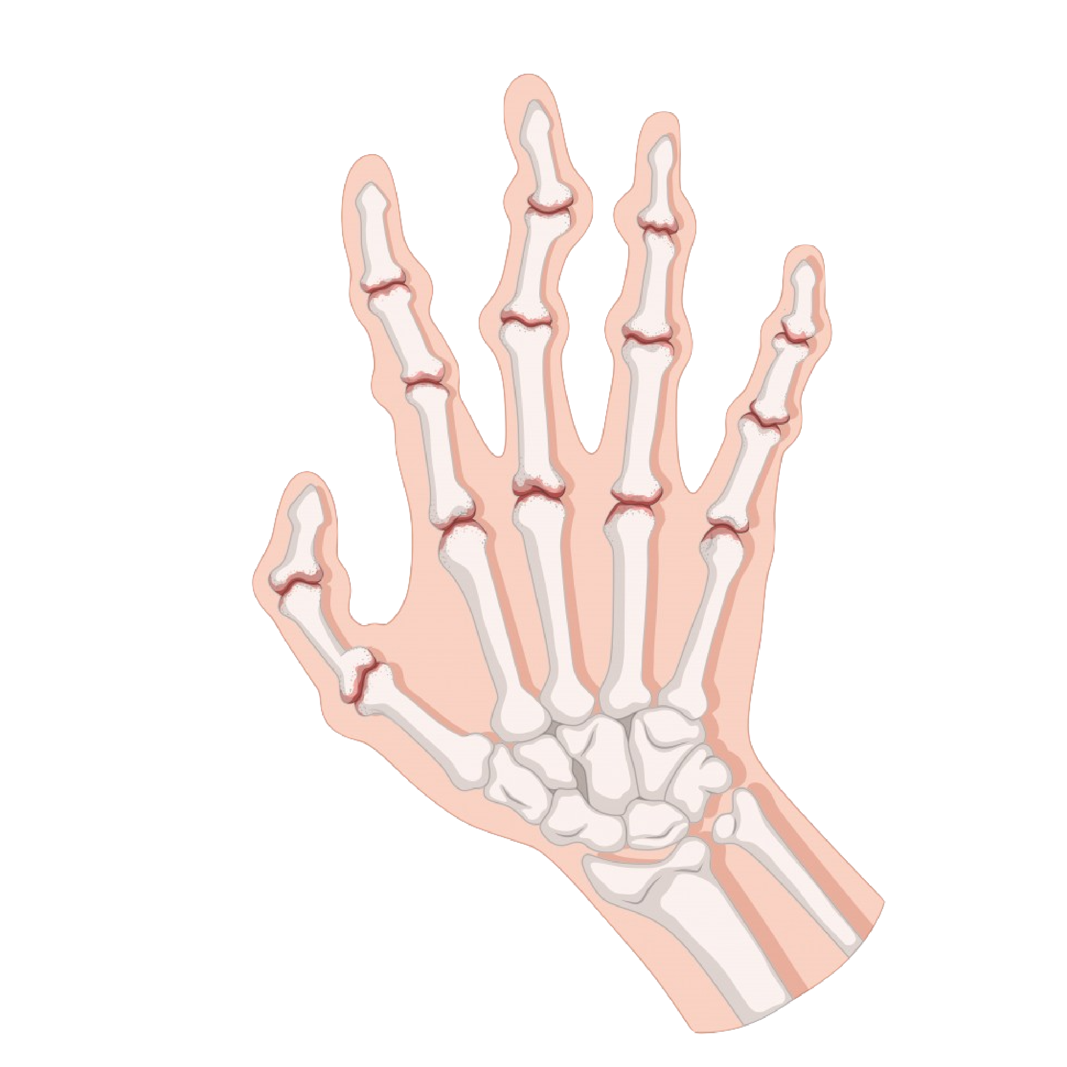 Rheumatoid Arthritis