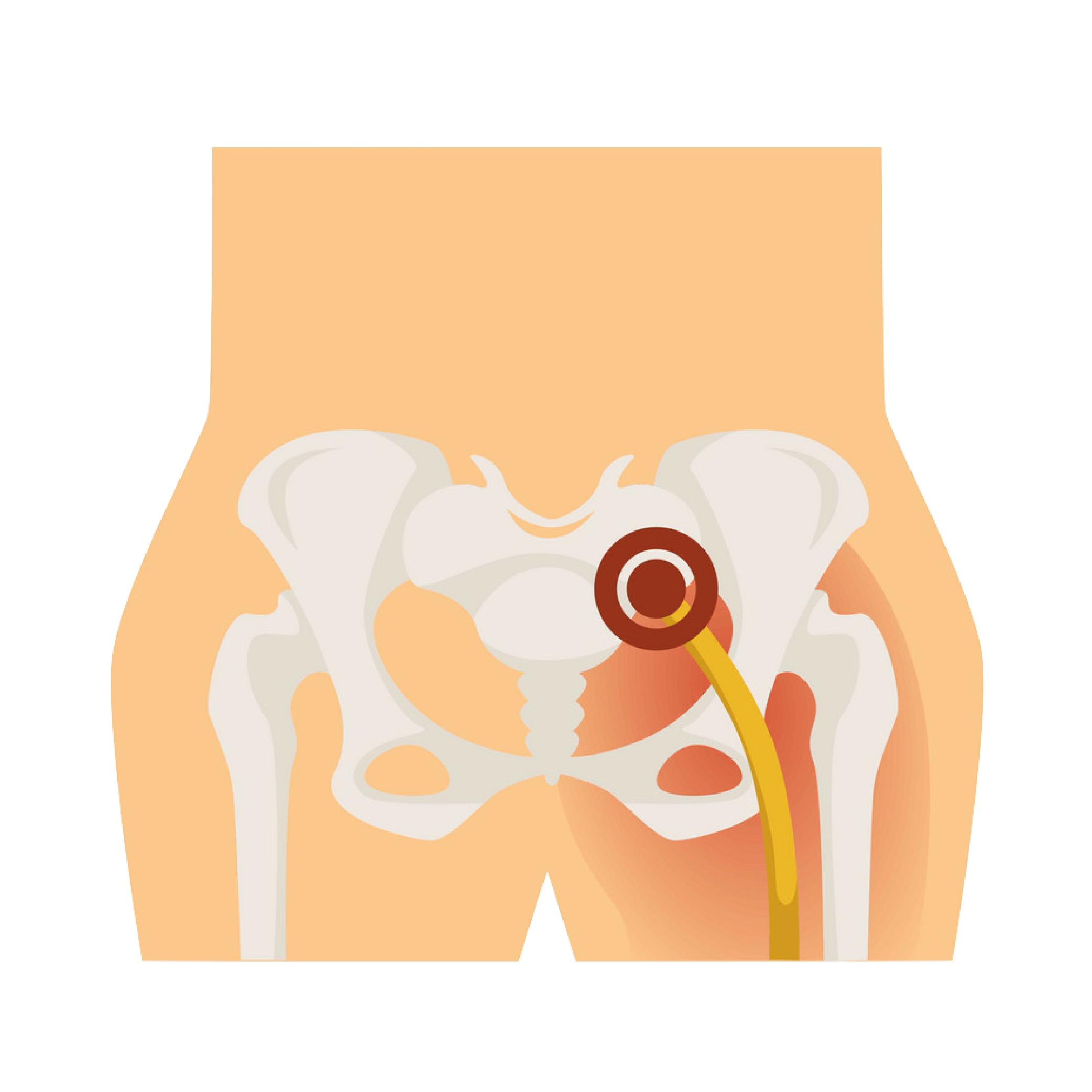 Sciatica