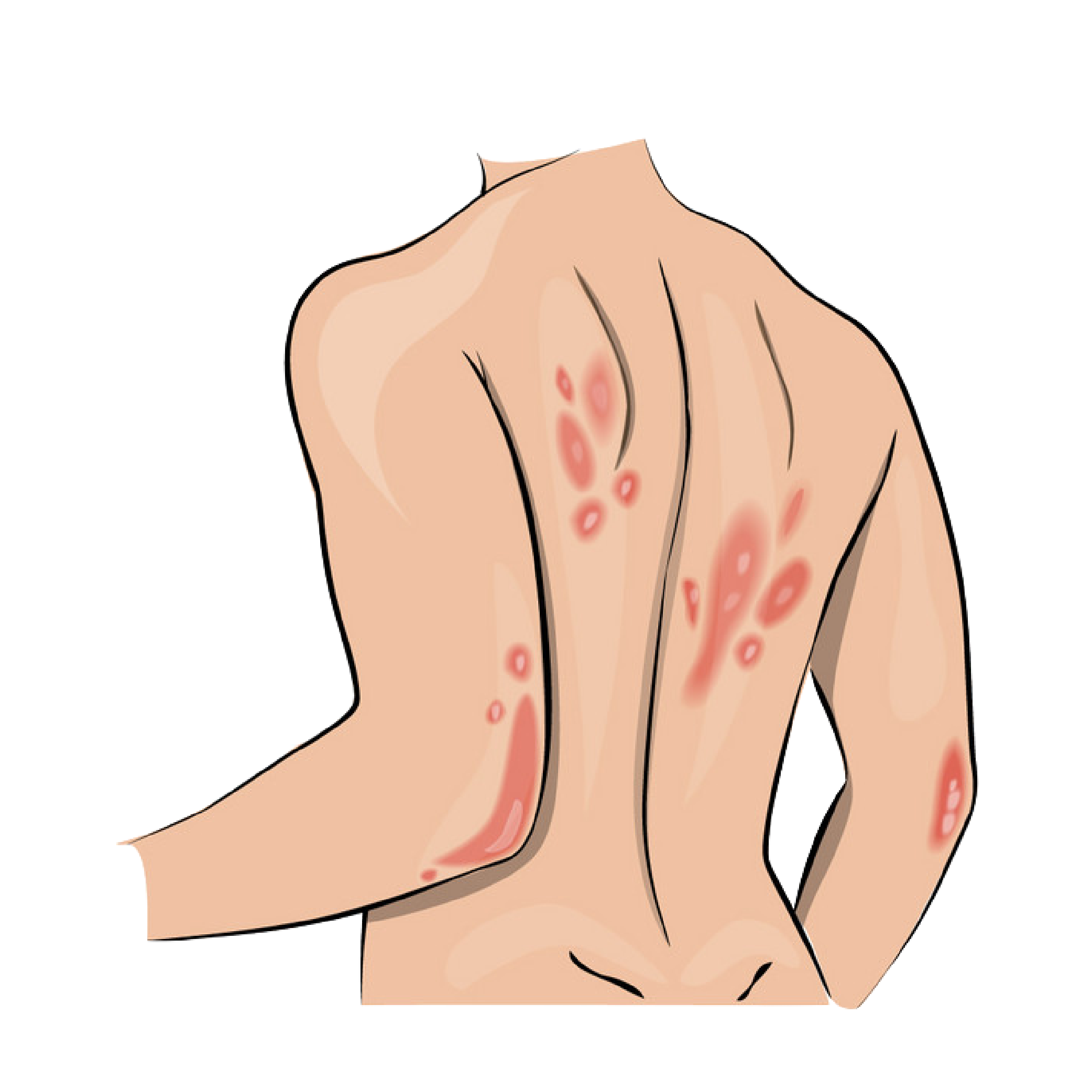 Psoriasis