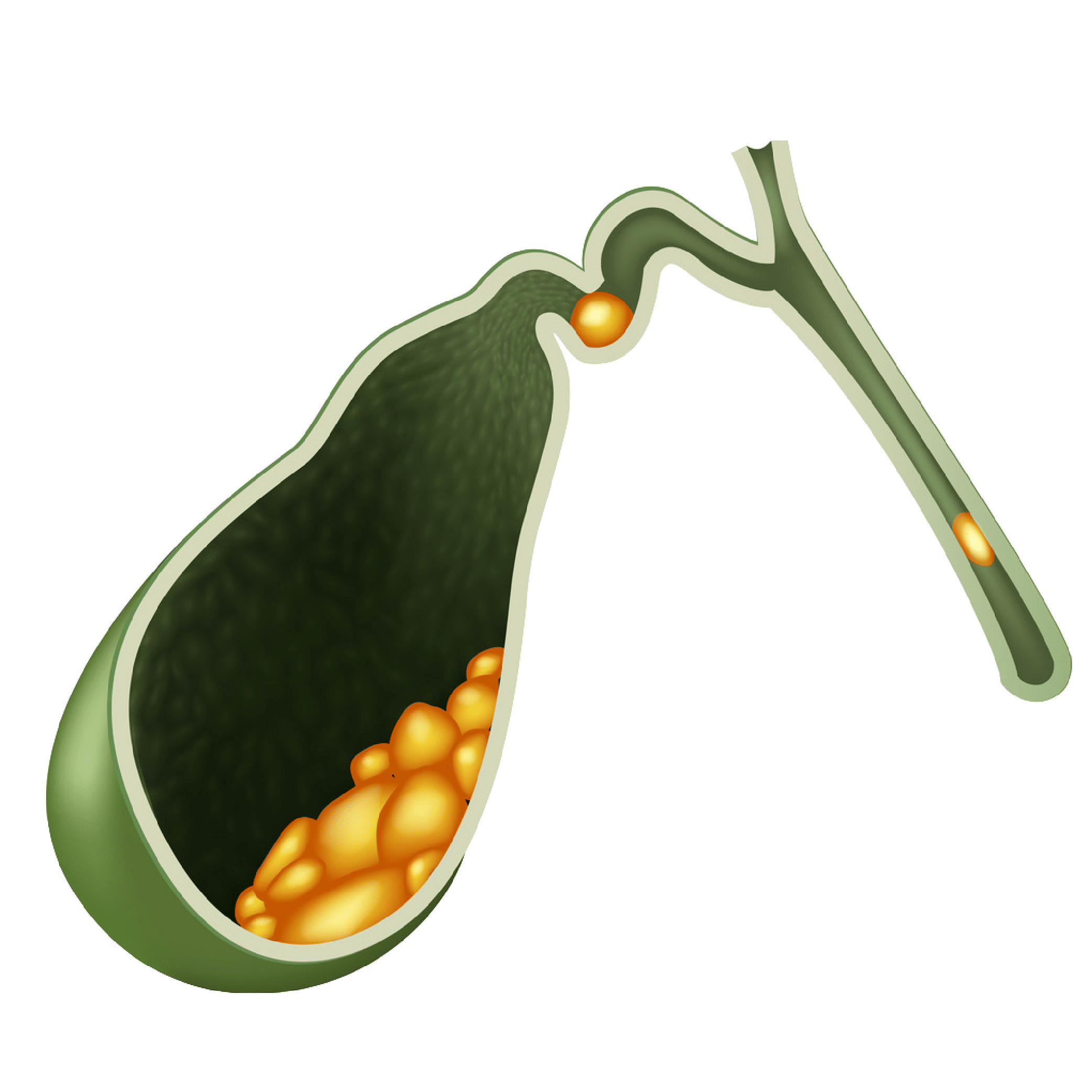 Gall stones